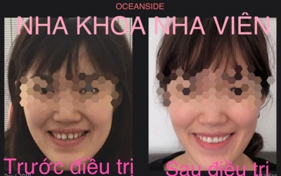 Tháo mắc cài là tháo mắc cài...quận tân phú  ( khám và tư vấn miễn phí)